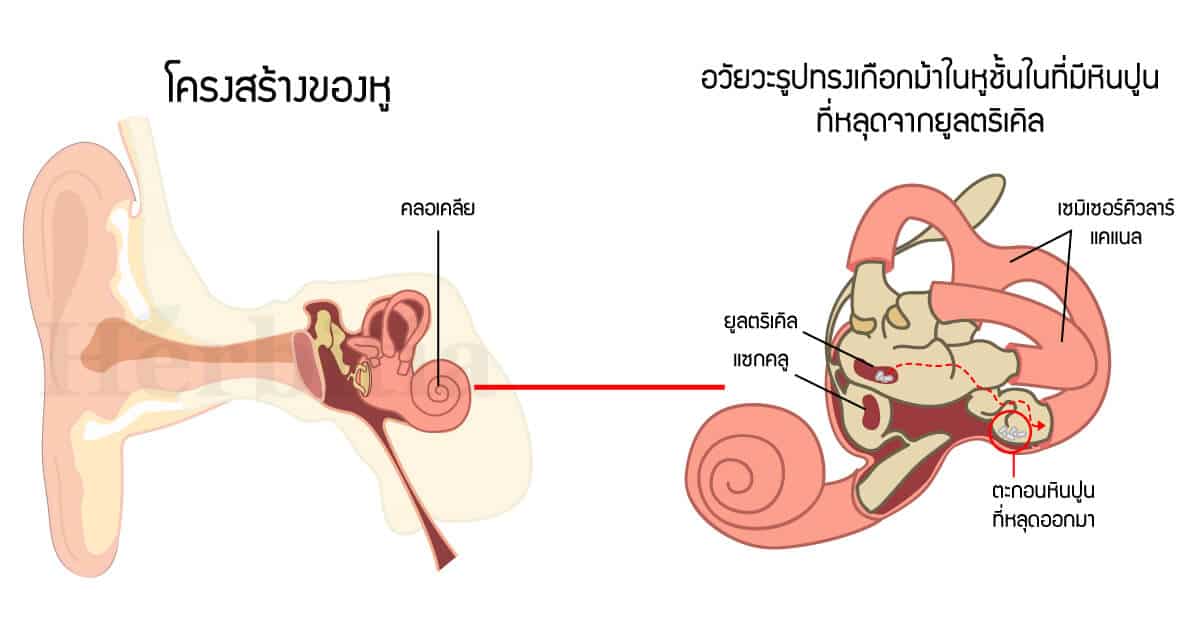 โรคตะกอนหินปูนในหูชั้นในหลุด (BPPV) สาเหตุหนึ่งที่ทำให้เวียนหัว บ้านหมุน