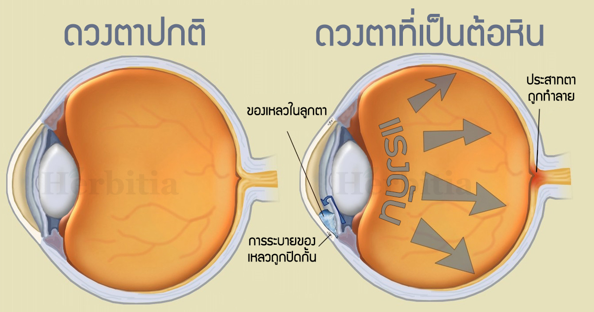 งานวิจัย ป้องกันตาบอด จาก 