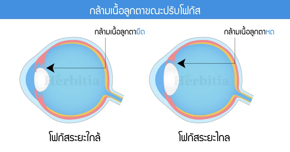 "วุ้นในตาเสื่อม" โรคยอดฮิตของคนติดจอ - 5