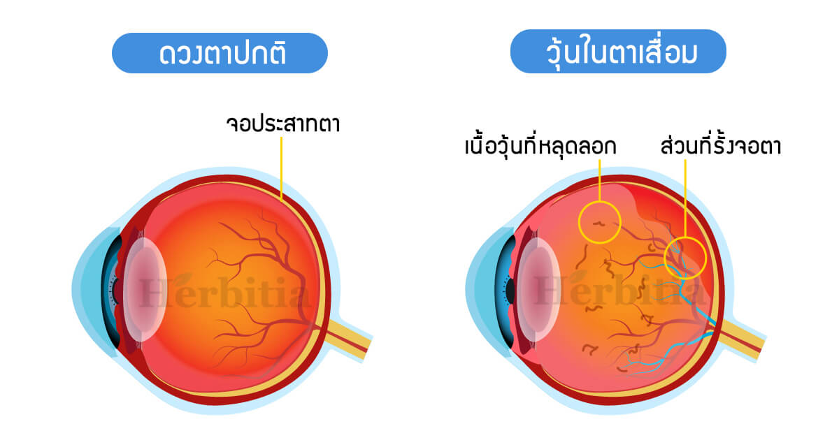 "วุ้นในตาเสื่อม" โรคยอดฮิตของคนติดจอ - 2