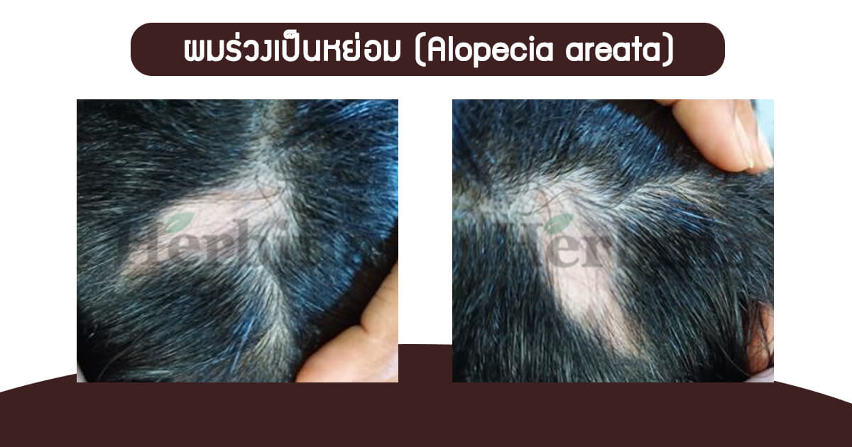 ผมร่วงเป็นหย่อม (Alopecia areata)